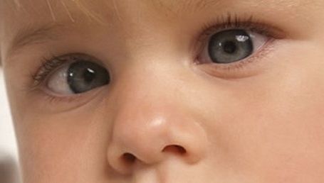 Bebeklerde Göz Kayması Neden Olur?