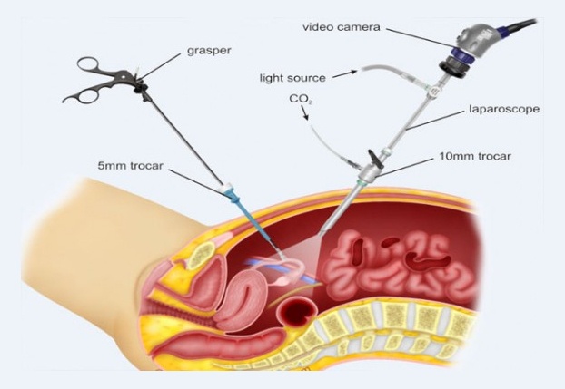 Histeroskopi (rahim içi yıkama) nedir, nasıl yapılır?
