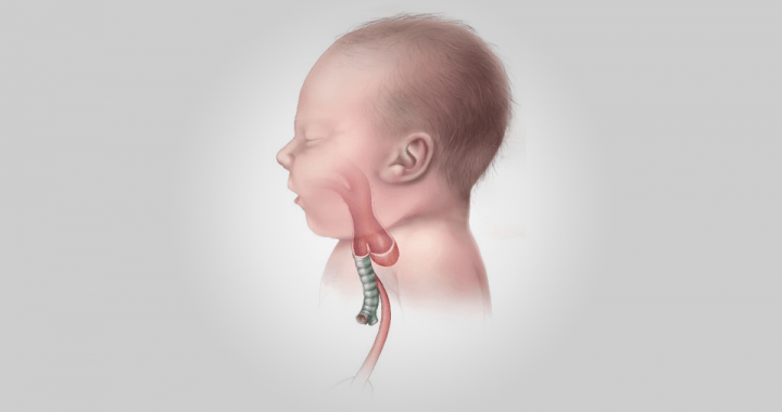 Bebeğinde Doğuştan Yemek Borusu Problemi(özofagus atrezisi)