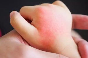 Çocukları tehdit eden 3 yaz alerjisi: Polen, güneş ve böcek alerjileri
