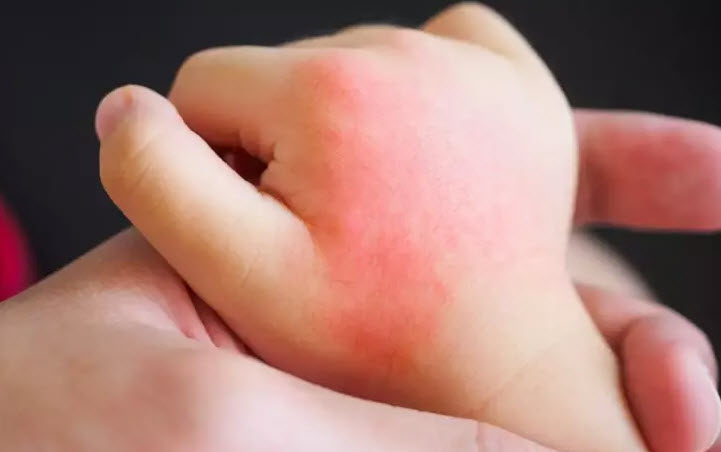 Çocukları tehdit eden 3 yaz alerjisi: Polen, güneş ve böcek alerjileri
